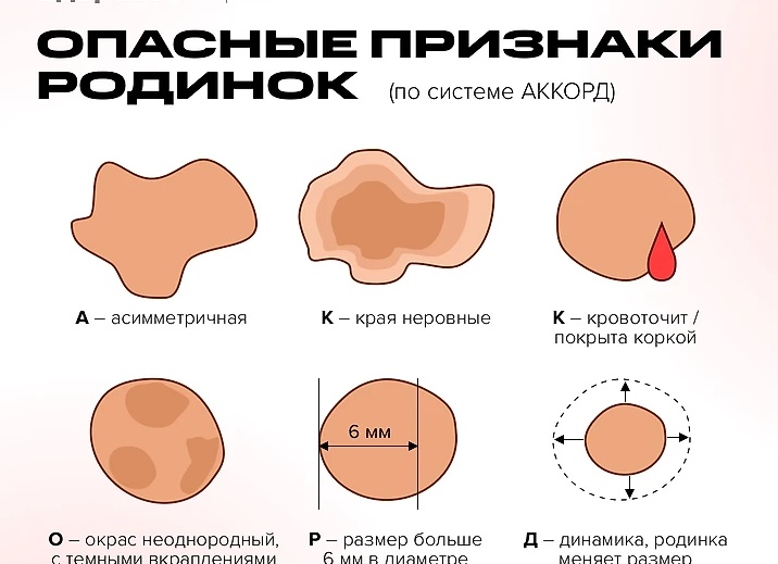Пятно, родинка или опасный сигнал: как отличить доброкачественное образование кожи от злокачественного